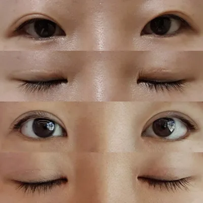 Mình đã phẫu thuật mắt được 2 tháng