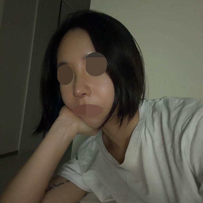 원트 김현우원장님한테 코재수술 (자가늑) 받은 후기