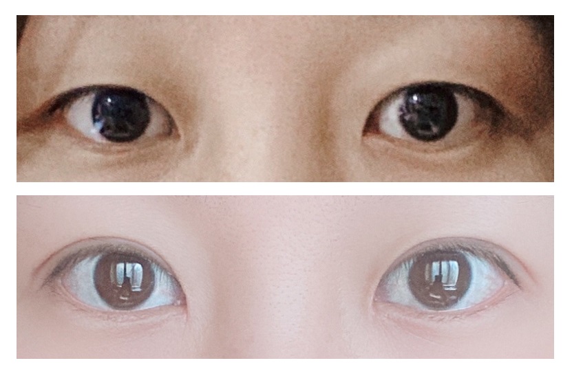 Review 3 tháng sau cắt mí