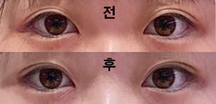 Mình làm mắt hai mí kiểu nhấn mí ạ!