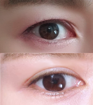 Cắt mí mắt (phương pháp rạch) ưng ý lắm nha!