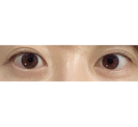 Sửa mắt hai mí tự nhiên quá trời!