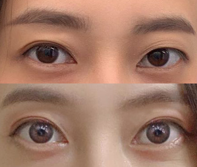 Review sau 6 tháng tái phẫu thuật