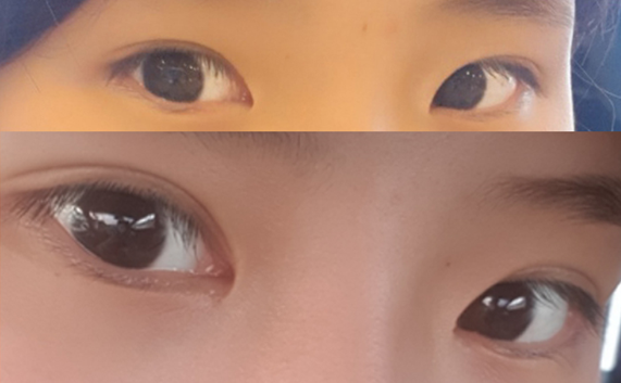 Review 2 tháng sau cắt mí trước và tái phẫu thuật mắt 2 mí ~