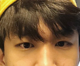 Review sau 1 tháng cắt mí mắt cho nam!