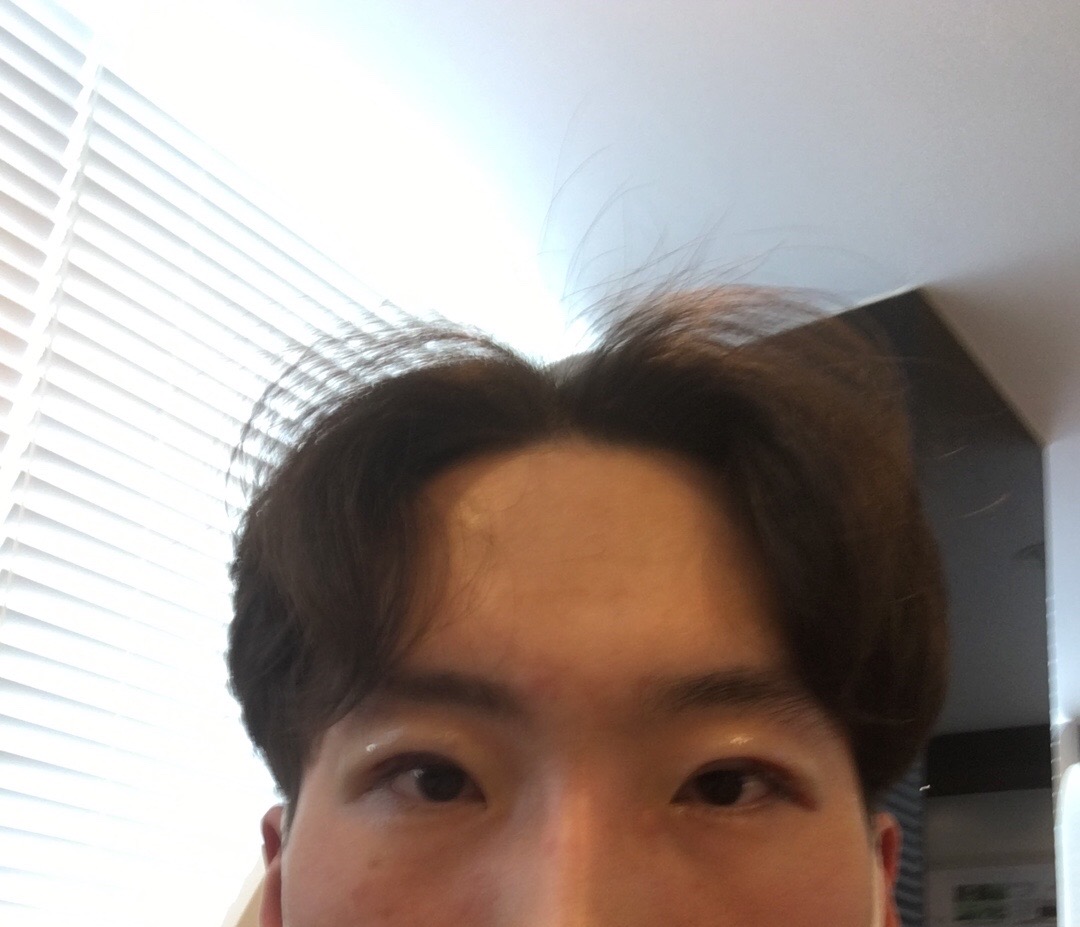 Review sau khi cắt mắt hai mí điều chỉnh cơ nâng mí của nam.