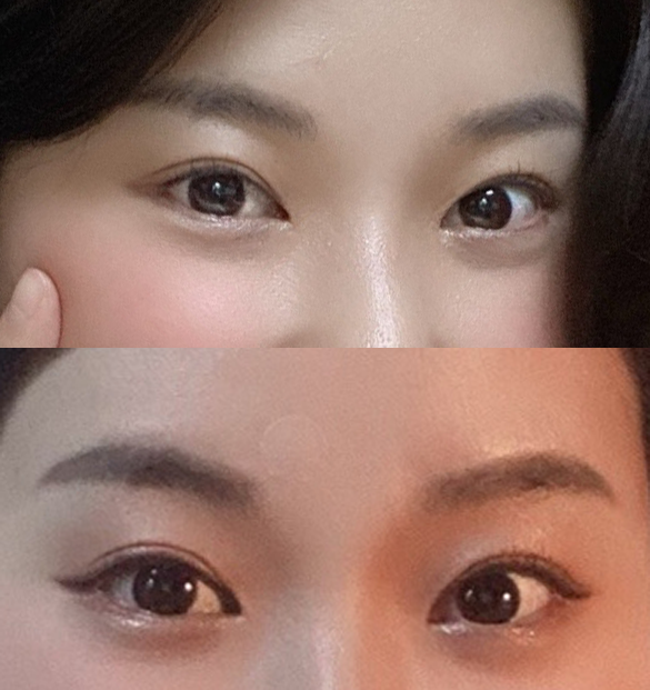 Báo cáo kết quả sau 1 năm tái phẫu thuật mắt (mắt sưng như xúc xích), tái phẫu thuật mở góc mắt trước, mở góc mắt sau và dưới