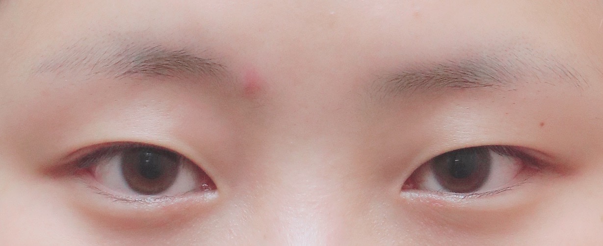 Sửa mắt một tháng rồi ^^