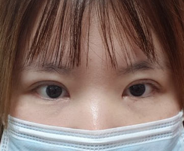 Review cắt mí lại, cắt góc mắt trước sau khi tháo chỉ