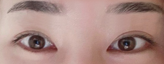 Cắt mí mắt, mở góc mắt trước được hai tháng rồi ạ