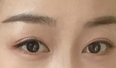 Review 6 tháng sau cắt mí mắt và mở góc mắt trước