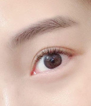 Cắt mí mắt và chỉnh sửa cơ nâng mi!!