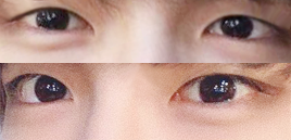 Review về cắt mí mắt cho nam không mí lót, mở góc mắt trước