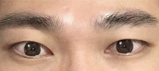 Chỉnh sửa mắt một mí cho nam