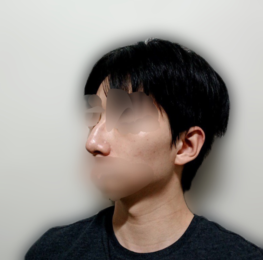붓기가 점점 빠지면서 자연스러우면서도 코가 세련되게 예뻐져서 만족스러웠습니다.