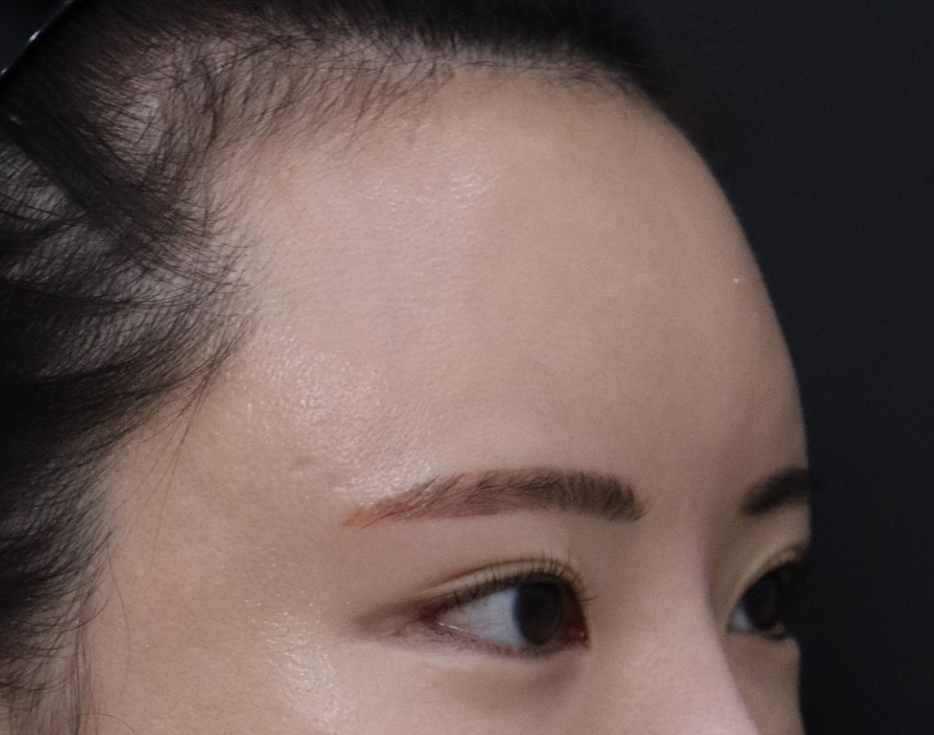 수술 당일엔 좀 아팠지만 효과가 있어서 너무 좋았어요!  눈이랑 눈썹 사이도 넓어지고 이마는 줄어들었어요~^^