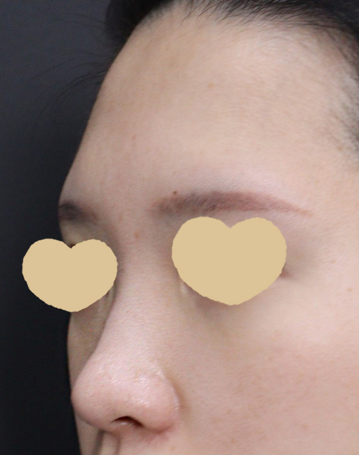 ​첫코수술로 선택한 병원은 모델님 보고 홀딱 넘어간 베리굿 성형외과였어요:)