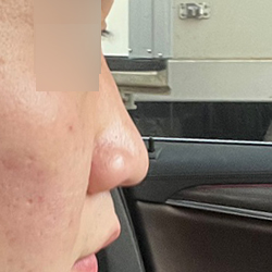 ​낮은코에 넓은코가 콤플랙스였는데,  일단 수술 경과시간에 비해서 벌써 만족스럽습니다.