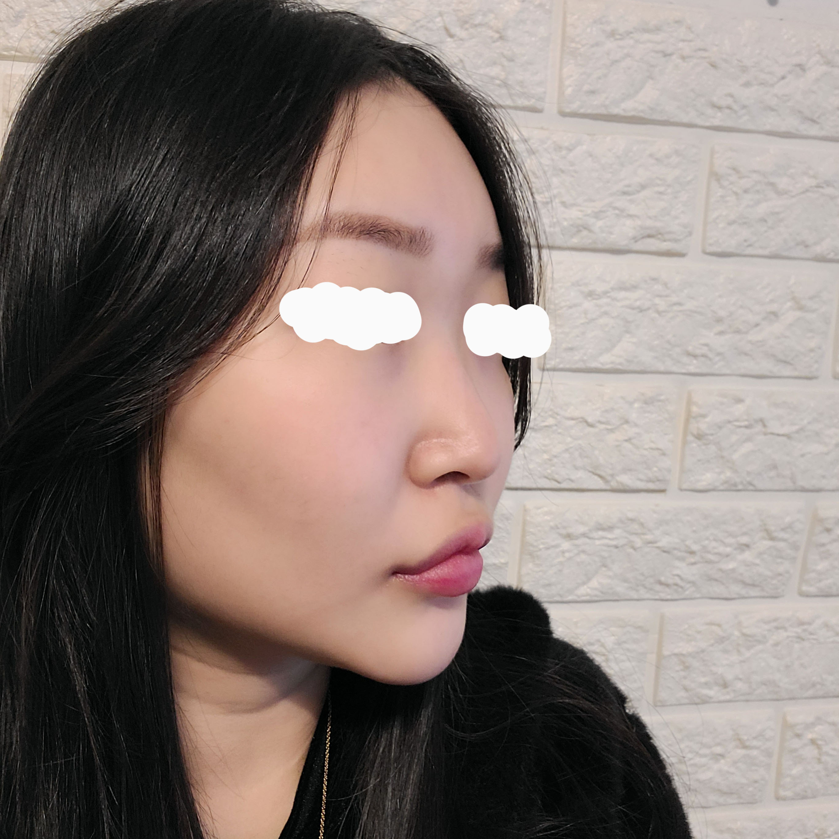 예쁜 코 만들어주신 임영민원장님 비염도 없애주신 남재성원장님  감사해용~