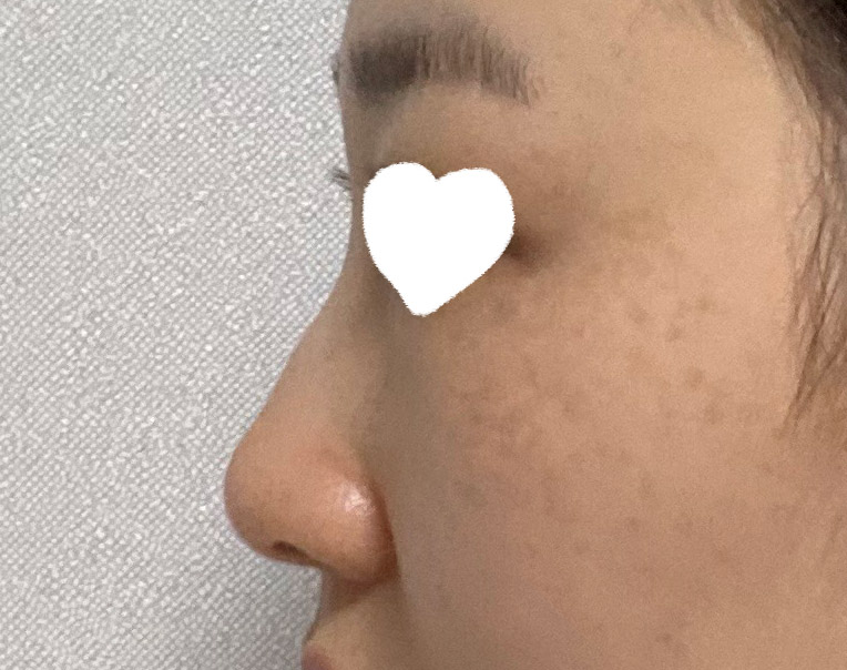 비염수술 하는김에 매부리있던거 정리하고   코수술 같이 진행 하게되었습니다