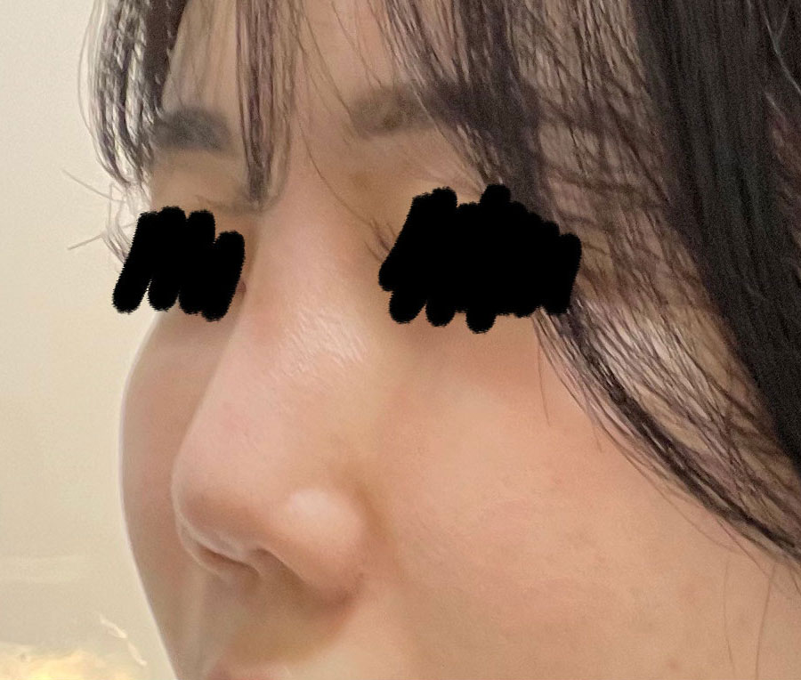 수술결과는 정말 대만족입니당 금손..원장님.. ^^*