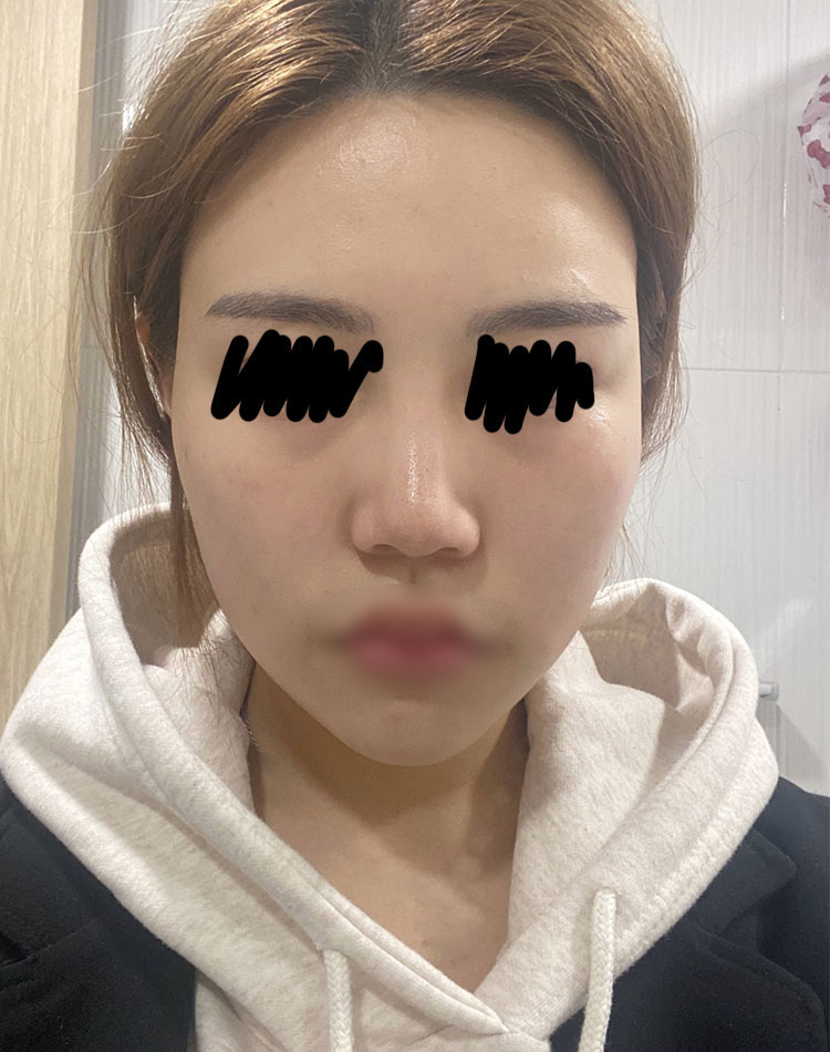 ​윤곽 3개월차 후기에용