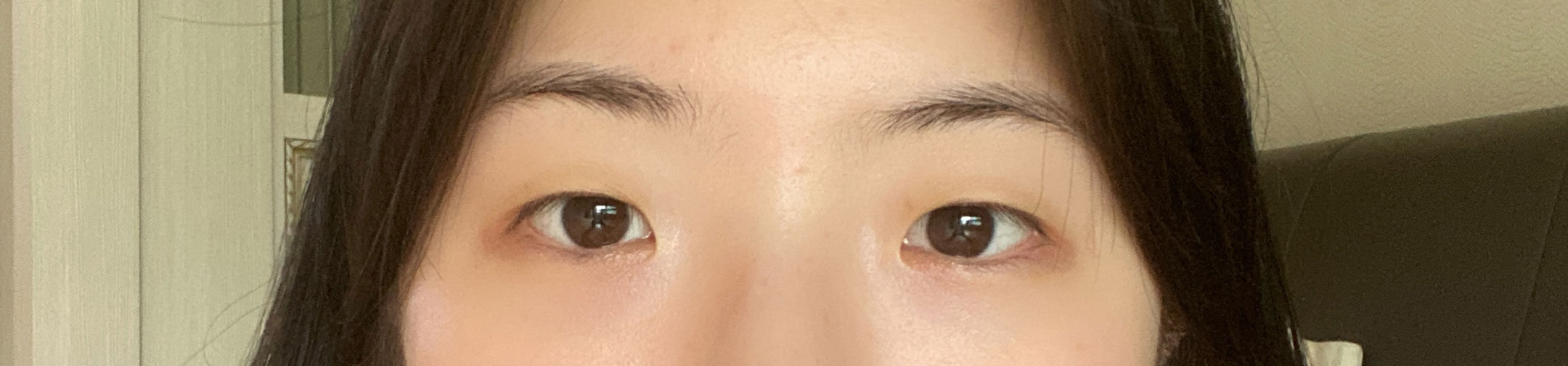 베리굿 성형외과 최태준 원장님께 눈성형을 받기로 결정했습니다.