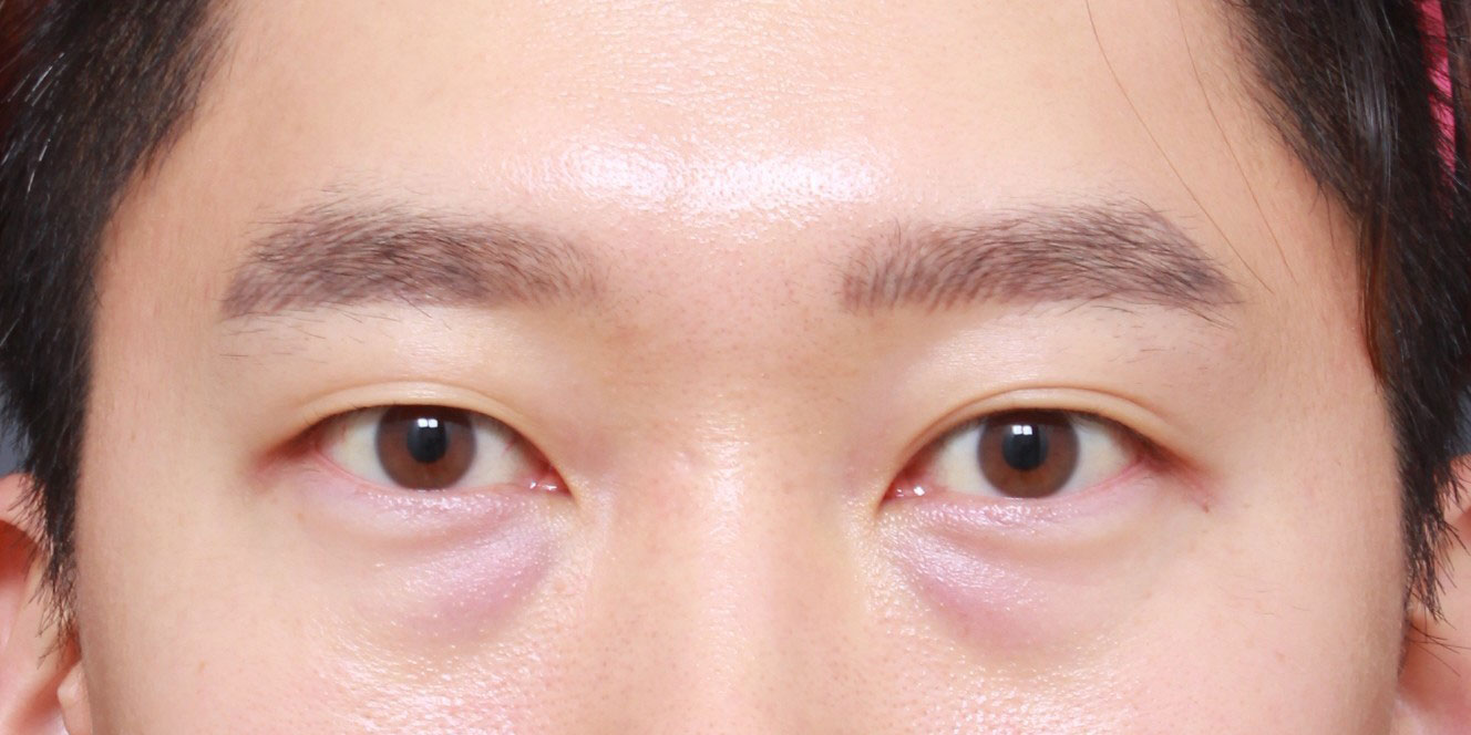 남자 눈밑지방재배치 후기입니다.