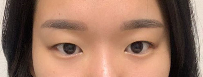 쌍커풀 있는 큰눈이 너무 갖고 싶어서 쌍수를 하게 되었어요!