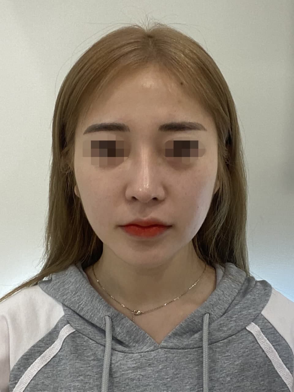 볼륨감이 좀 부족하다 생각해서 풀페이스로 지방이식했어요!