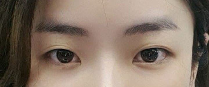 왜 절개를 생각했지 싶을정도로 또렷하고 너무 자연스러워요!