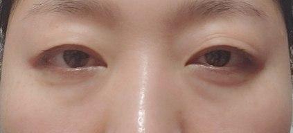 벌써 눈밑지방재배치수술한지 3개월넘었네요