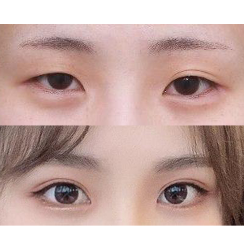 수술한지는 3개월차에요