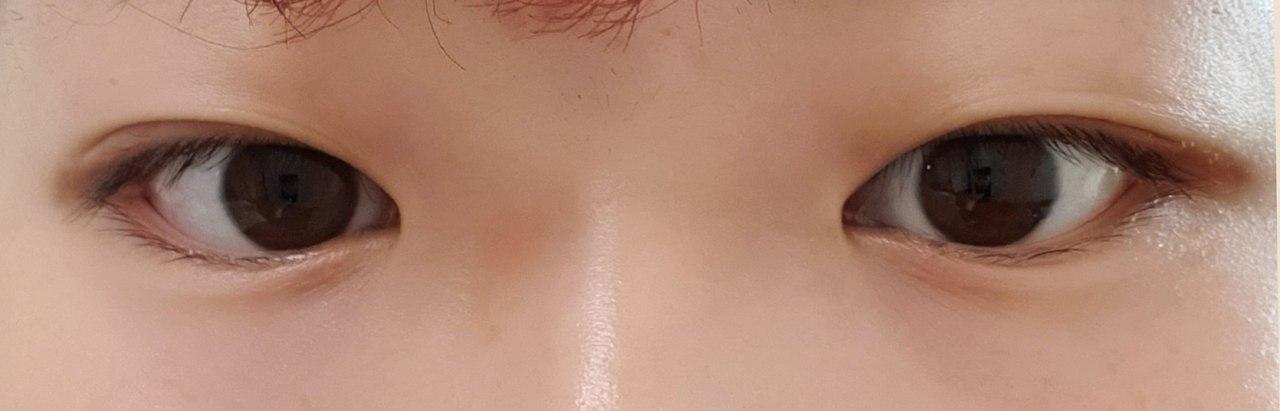 베리굿 성형외과 손원일 원장님 후기입니다.