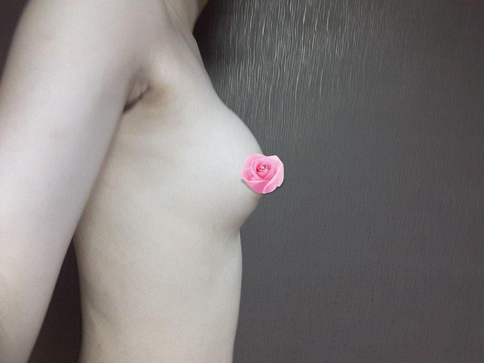 수술한지 3개월정도 지났어요~