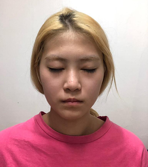 코 | 지방 | 기타 수술후기