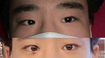 눈 수술후기
