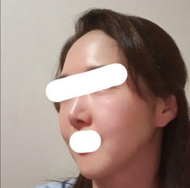 리프팅 | 지방 수술후기