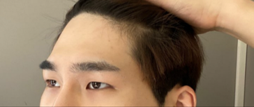 눈 | 리프팅 수술후기