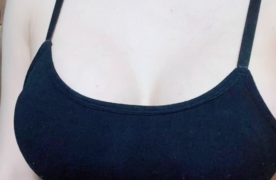 세빈인테  6개월차) 6개월차 멜론가슴! 너무 너무 만족해요❤️