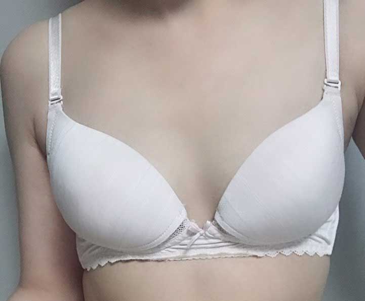 Mình đã phẫu thuật thẩm mỹ ngực sau sinh!