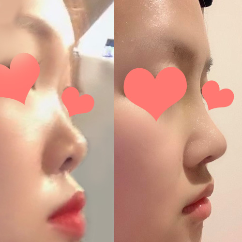 Review sau phẫu thuật nâng mũi!!