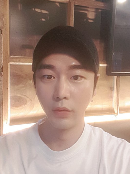 Mình đã thực hiện căng chỉ và cấy mỡ trán ~