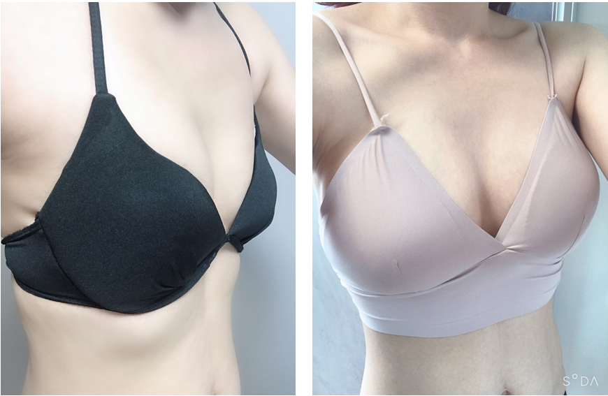 Phẫu thuật nâng ngực tăng thể tích