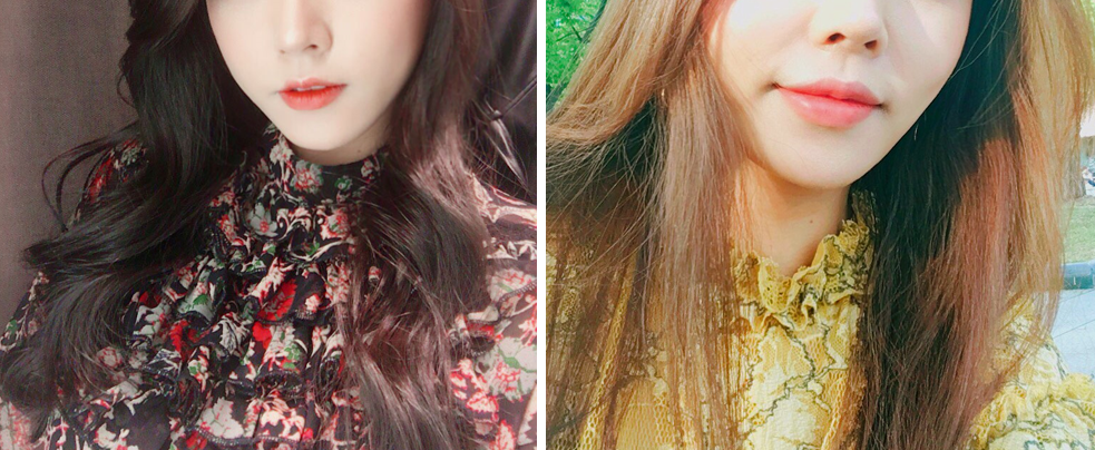 Tiêm filler khóe môi