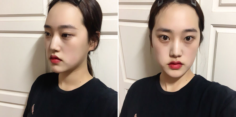 Mình đã phẫu thuật thu nhỏ xương hàm vuông, gọt cằm, cắt bỏ vỏ xương và phẫu thuật mũi như thế này! ==== 3333