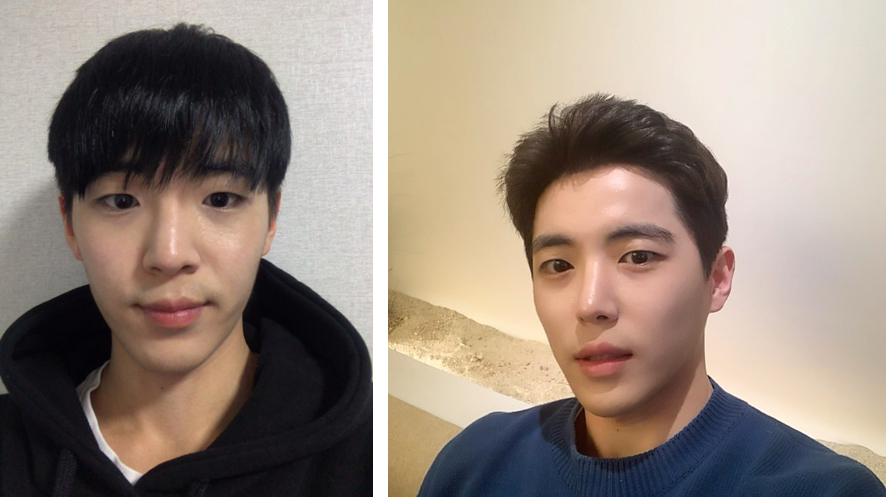 Mình đã phẫu thuật chỉnh sửa mắt, mở góc mắt và phẫu thuật mũi.