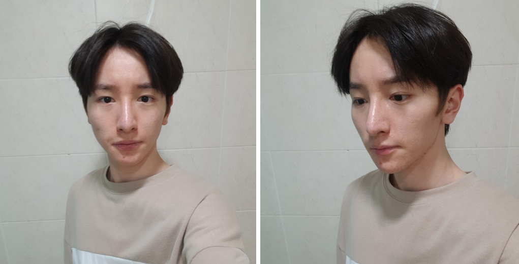 Gọt mặt, Nâng mũi, Cấy mỡ toàn mặt