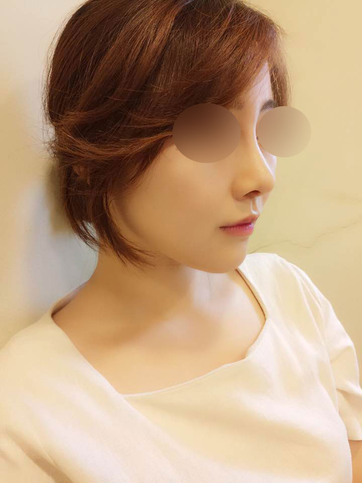 Sống mũi, đầu mũi, độn cằm, laser Venus