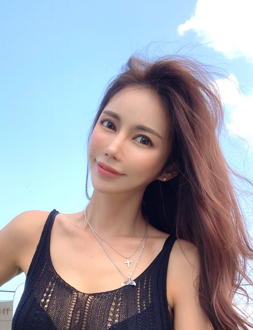 Nâng cơ mặt mini, cấy mỡ, hút mỡ (má)